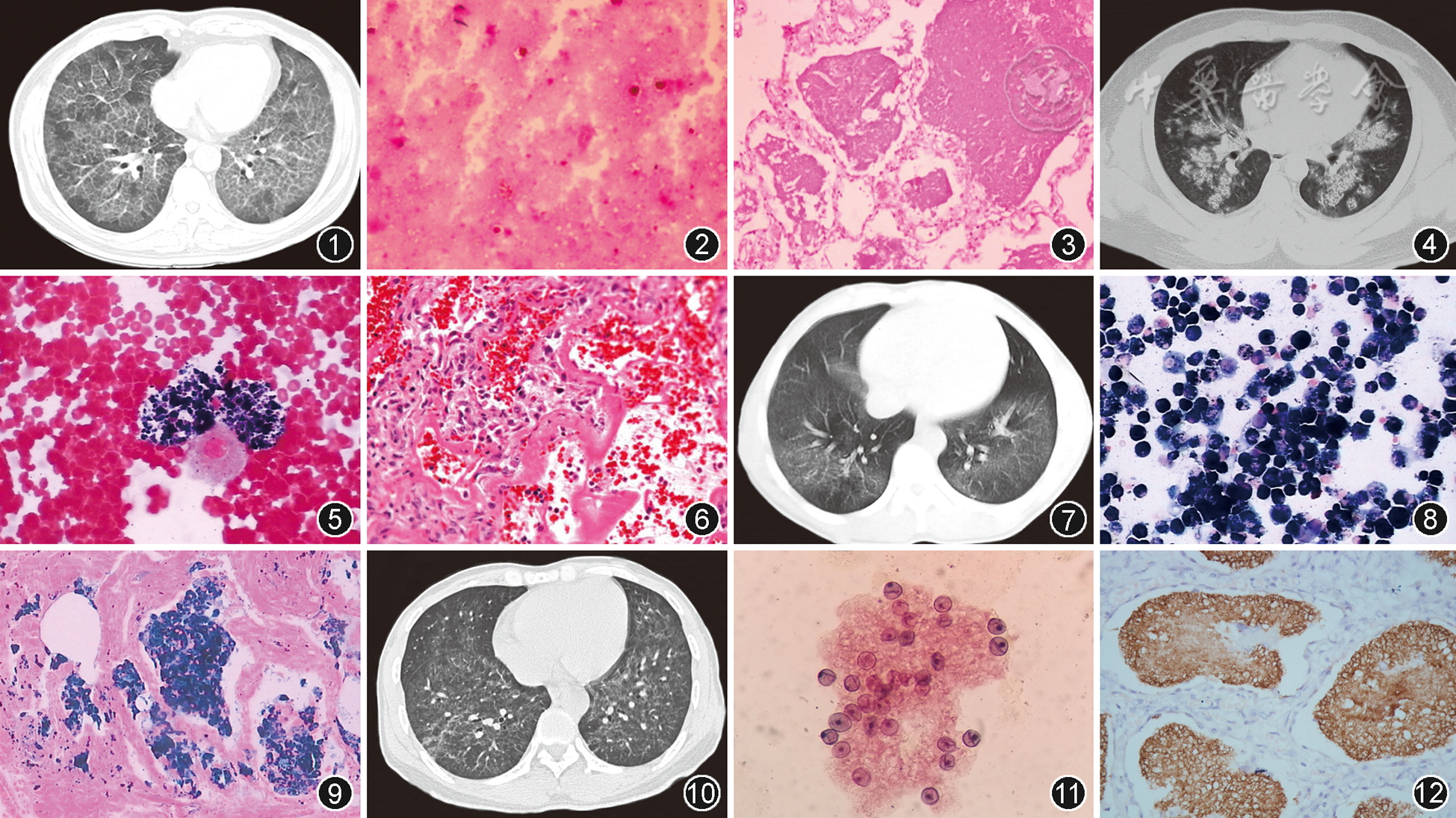 【争鸣】弥漫性肺泡填充性疾病的临床、影像和病理特征