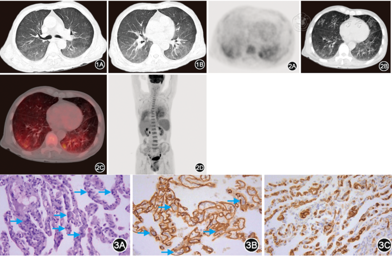 血管内大B细胞淋巴瘤肺受累1例