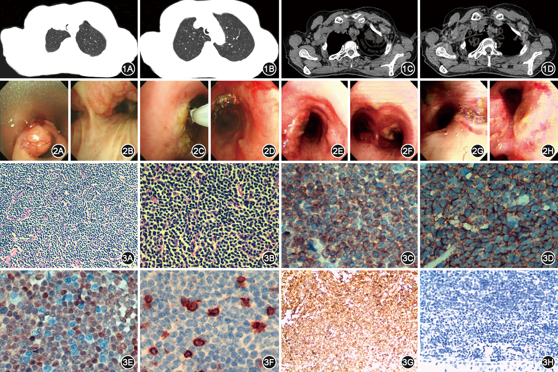 气管内套细胞淋巴瘤1例