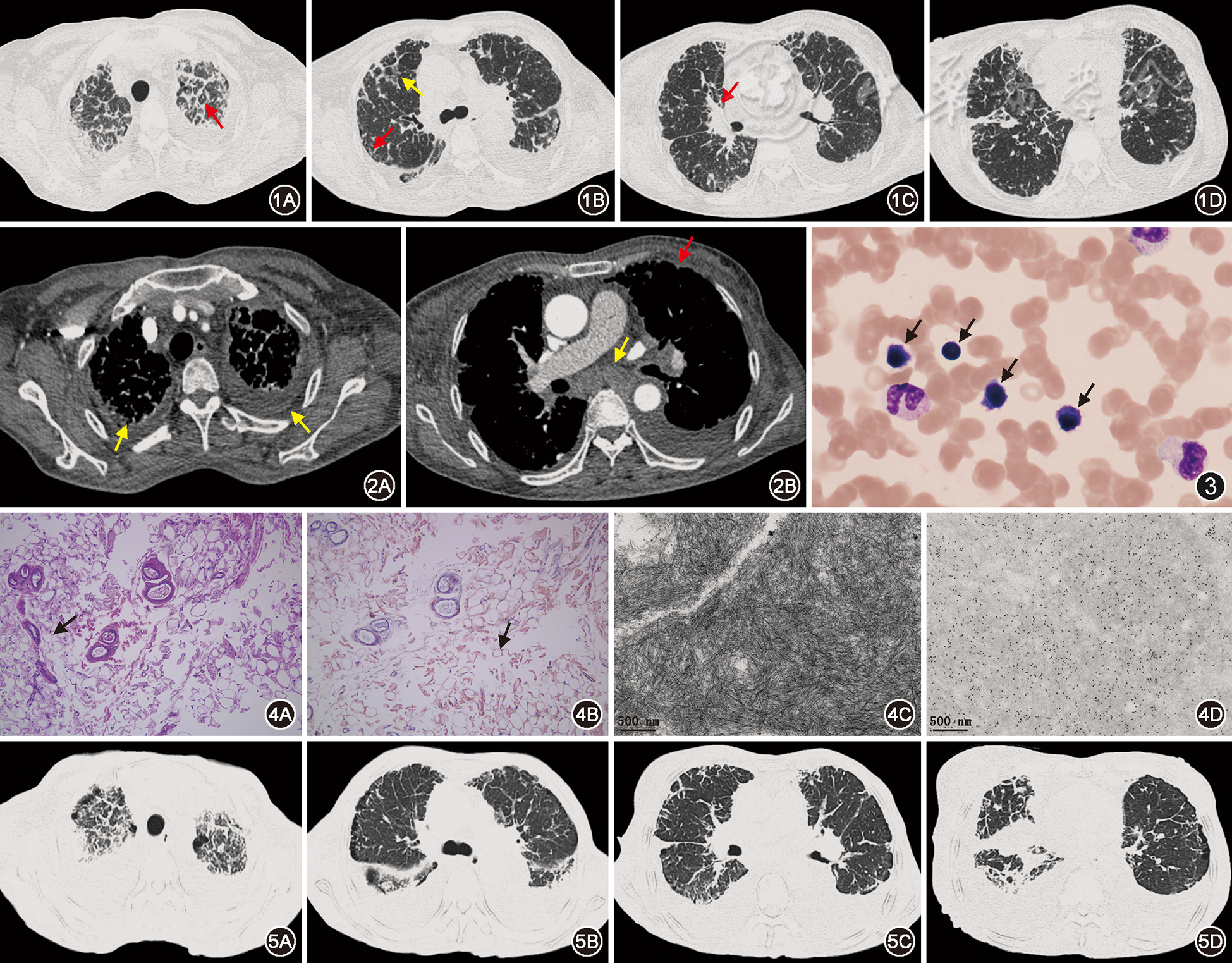 以肺间质病变伴胸腔积液为首发表现的原发性淀粉样变1例