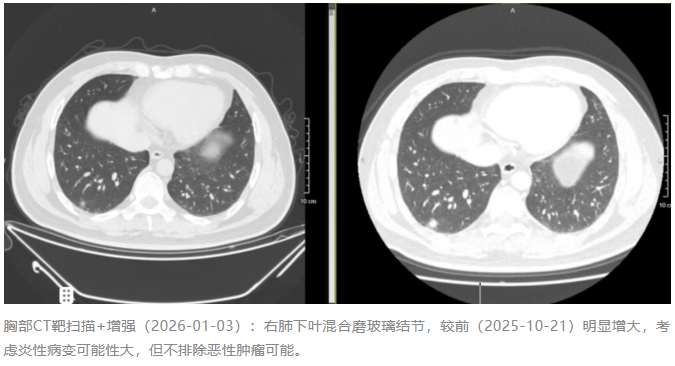 血清隐球菌抗原阴性,肺结节却疯狂生长……智能机器人与mNGS联手精准识破这场“完美伪装”!